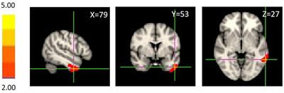 The neural correlates of perceived social support and its relationship to psychological well-being